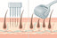 Derma stamp vs derma roller for hair growth — cross-section diagram comparing vertical stamp needle entry with angled roller needle entry in the scalp
