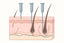 Microneedling for hair growth — needle depth guide showing 0.25 mm, 0.5 mm and 1.5 mm penetration in a scalp cross-section