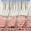 Microneedling for hair growth: copper peptide GHK-Cu serum entering the scalp through microchannels made by the Hairgenetix derma stamp